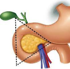 Síndrome de Zollinger-Ellison
