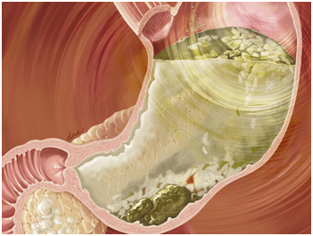 Gastroparesia y Obstrucción Intestinal Crónica Pseudo-Obstructiva