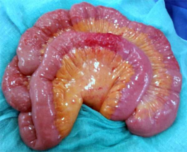 Tuberculosis intestinal