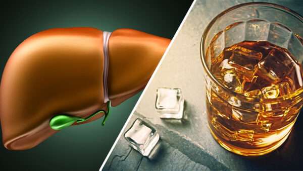 Enfermedad hepática asociada al alcohol