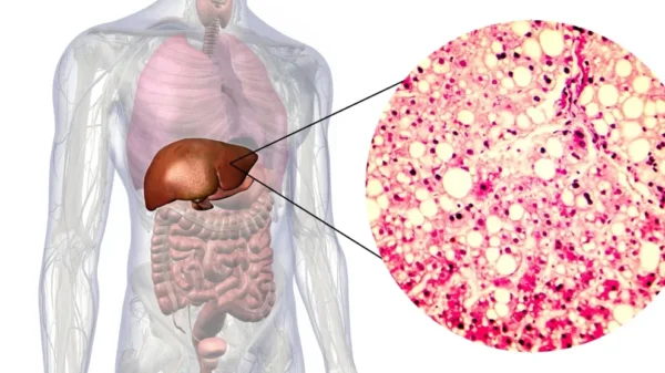 Enfermedad hepática esteatótica asociada a disfunción metabólica