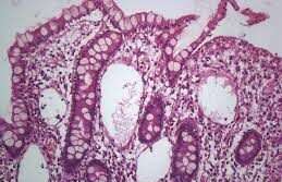 Enteropatía por pérdida de proteínas
