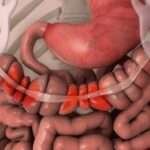 Patogénesis del Síndrome del intestino irritable