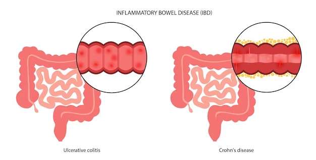 ¿Qué es la enfermedad inflamatoria intestinal?