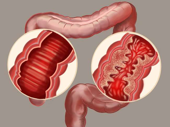 Tratamiento de la enfermedad de Crohn activa