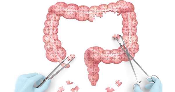 Indicaciones de cirugía para pacientes con enfermedad de Crohn