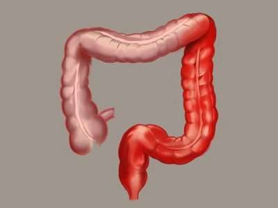 Diagnóstico de colitis ulcerativa
