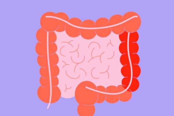 Tratamiento de la colitis ulcerosa leve a moderada