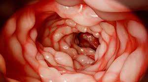 Tratamiento de la colitis ulcerosa moderada a severa