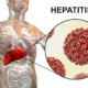 Hepatitis aguda B
