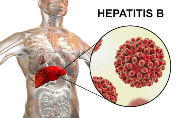 Hepatitis aguda B