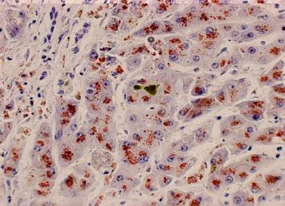 Enfermedad de Wilson