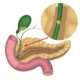Coledocolitiasis y colangitis