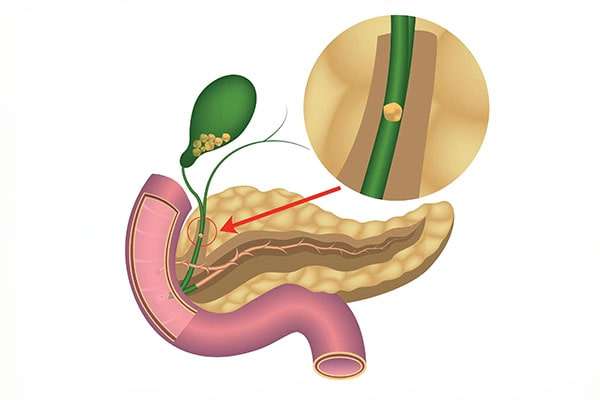 Coledocolitiasis y colangitis