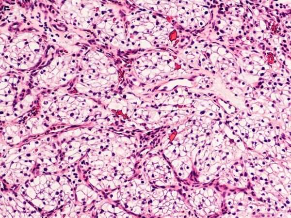 Carcinoma de células renales