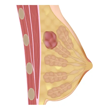 Fibroadenoma de la mama