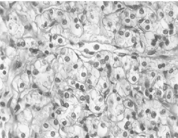 Sistema de graduación nuclear de Fuhrman
