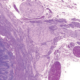 Neoplasia endocrina múltiple