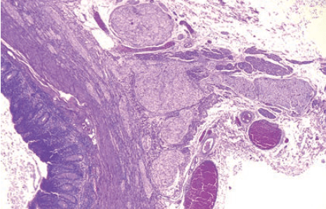 Neoplasia endocrina múltiple