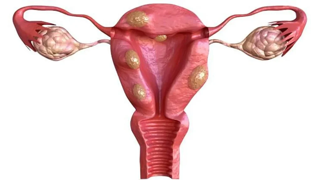 Leiomiomas uterinos (tumor fibroide)