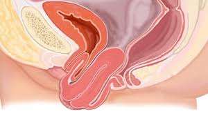 Prolapso de los órganos pélvicos