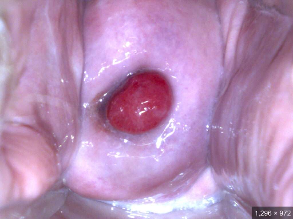 ¿Qué son los pólipos cervicales?