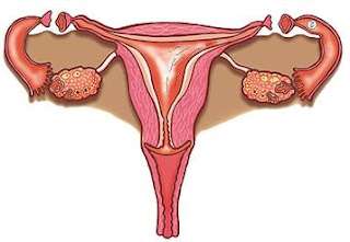 Anticoncepción permanente