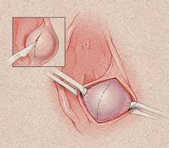 ¿Qué sucede cuando se obstruye el conducto de la glándula de Bartolino?