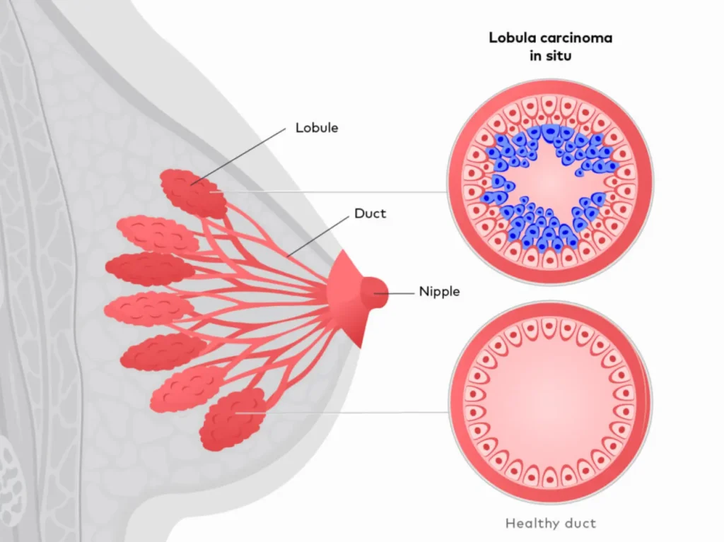 Carcinoma lobulillar in situ y Cáncer No Invasivo