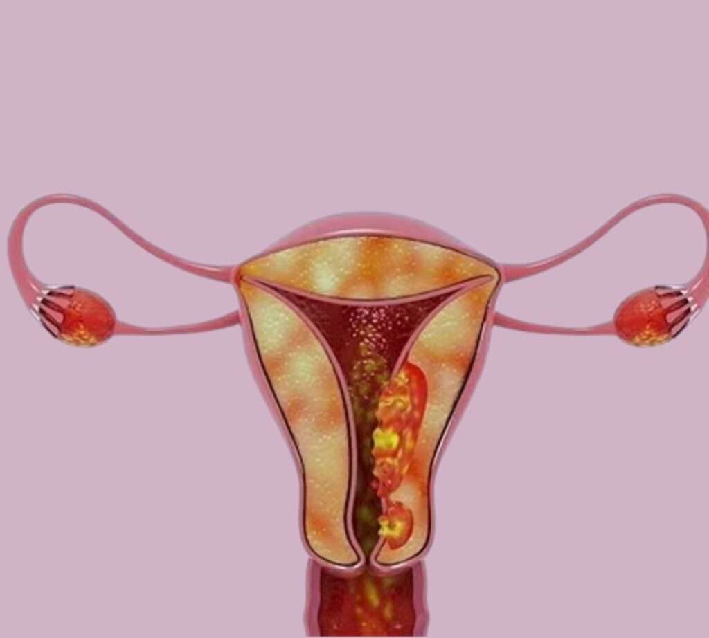 Carcinoma de endometrio