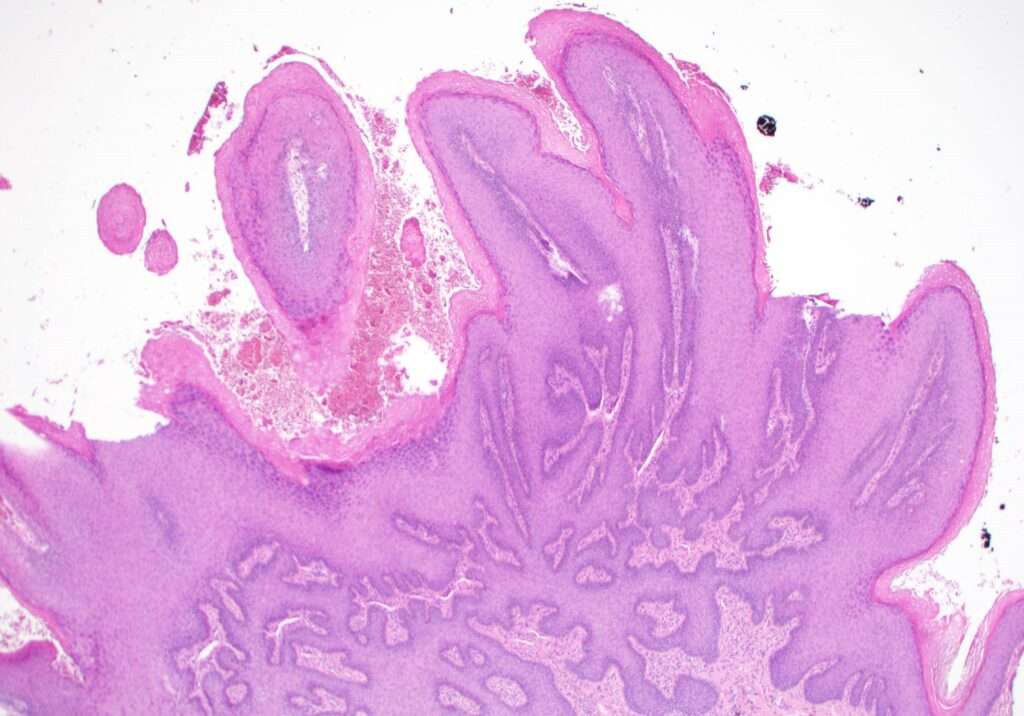 ¿Qué es el condiloma acuminado?