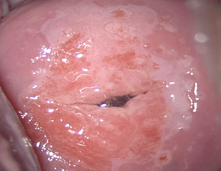 Neoplasia intraepitelial cervical