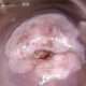Carcinoma del cuello uterino