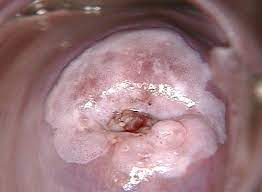 Carcinoma del cuello uterino
