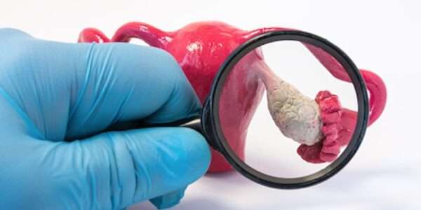 Tumores y cáncer de ovario