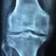 Osteoartritis