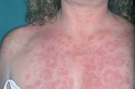 Lupus inducido por medicamentos