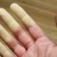 Causas de fenómeno de Raynaud secundario