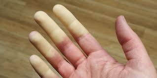 Causas de fenómeno de Raynaud secundario