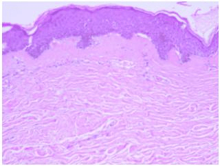Esclerosis sistémica o esclerodermia
