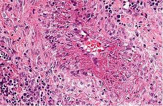 Granulomatosis con poliangiitis (granulomatosis de Wegener)