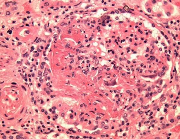 Poliangiitis microscópica