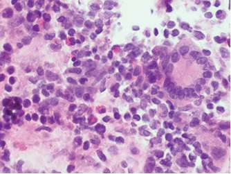 Granulomatosis eosinofílica con poliangeítis (síndrome de Churg-Strauss)