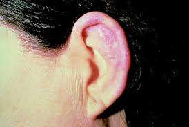 Policondritis recidivante