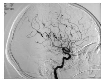 ¿Qué es la angiitis primaria del sistema nervioso central?