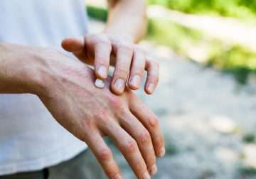 Manifestaciones reumáticas de la infección por el virus de inmunodeficiencia humana