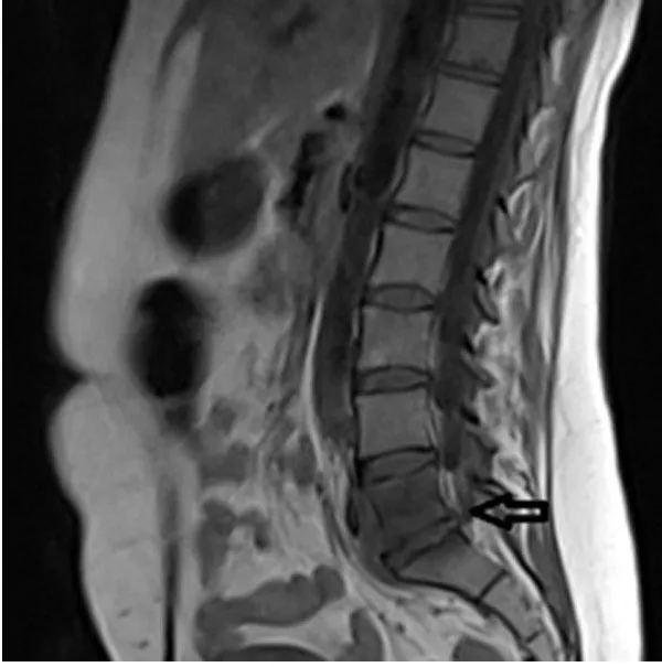 Tuberculosis espinal (Enfermedad de Pott)