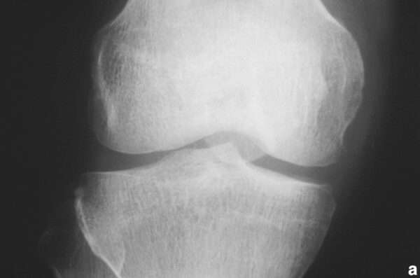 ¿Qué es la artritis tuberculosa?