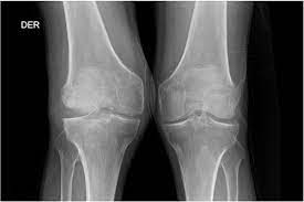 ¿Qué es la artropatía neurogénica?