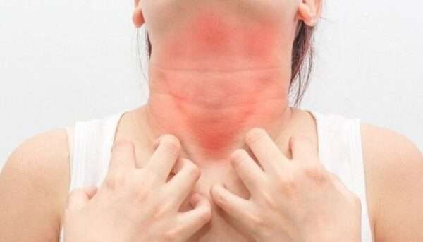 Reacciones adversas a medicamentos